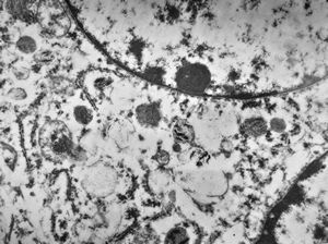 F,72y. | melanoblastoma oculi F,72y. | melanoblastoma oculi